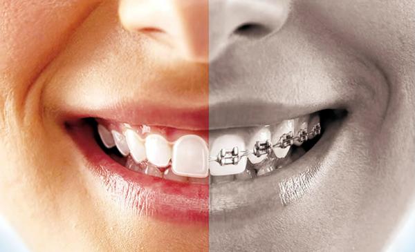 Ortodontik tedavi hangi yaşta yapılmalıdır?