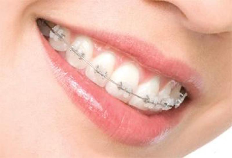 Ortodonti Nedir?